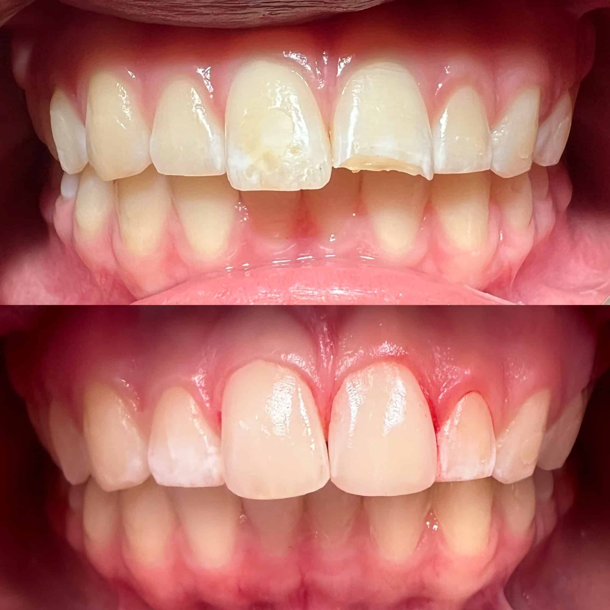 Before and After | Broken Tooth | Agape Dental